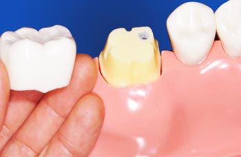 Best Dental Crowns Clinic Nangloi, Delhi